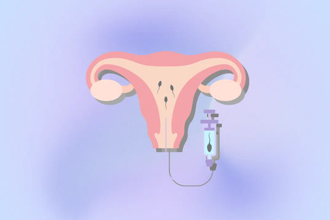 Intrauterine insemination