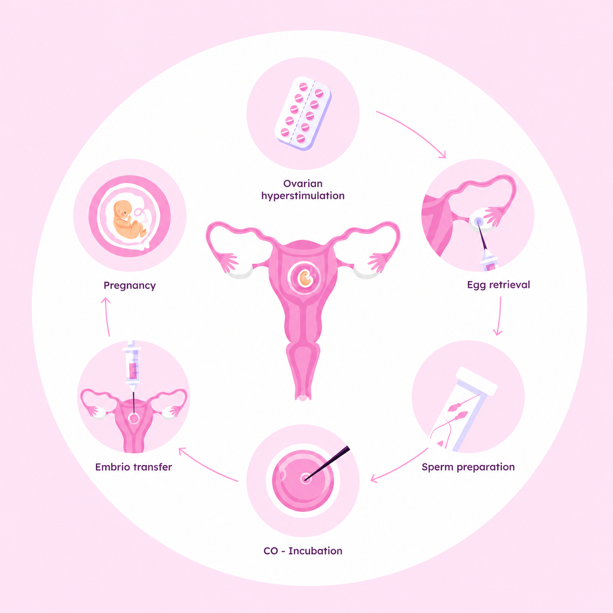 Simplified illustration of IVF stages from ovarian stimulation through embryo transfer